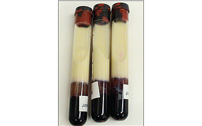 Hypertriglyceridemia blog